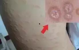 糙皮病轻度图片,早期识别与预防关键