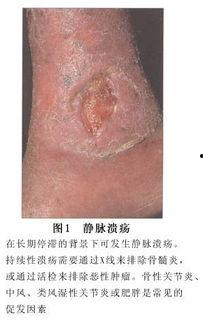 静脉炎的图片,症状与预防要点