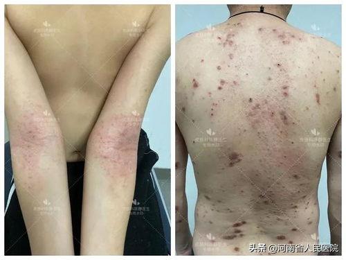 结节性湿疹图片,图片解析与症状概述