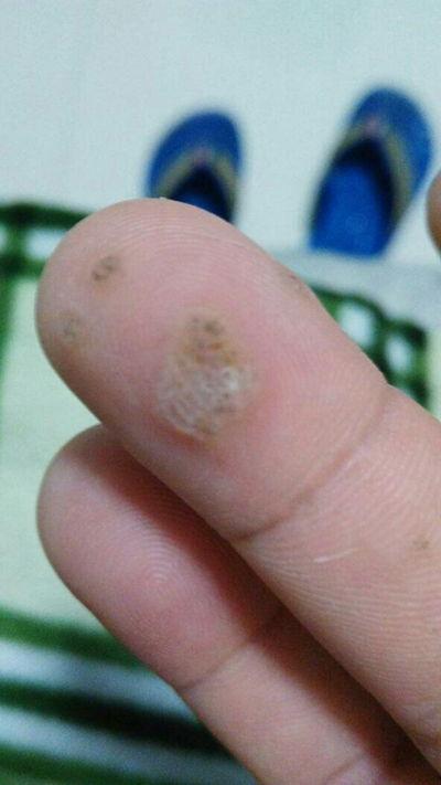 结节性湿疹图片,图片解析与症状概述