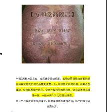结节性湿疹图片,图片解析与症状概述