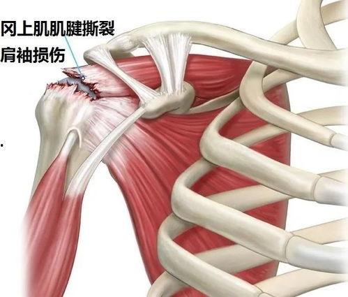 肩周炎位置图片,揭秘疼痛之源的解剖位置与防治策略
