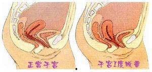 不正常子宫图片大全