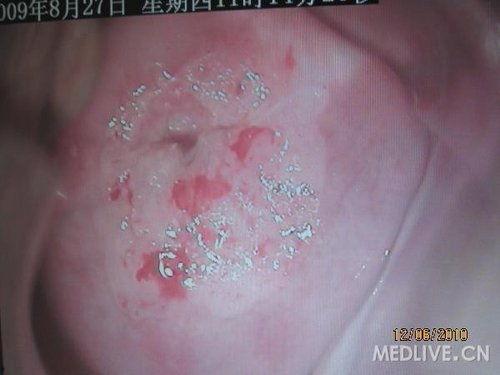 阴道镜检查视频,直观展现女性私密健康检查过程