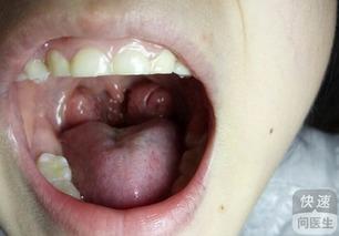 扁桃体发炎肿大图片,症状解析与应对策略