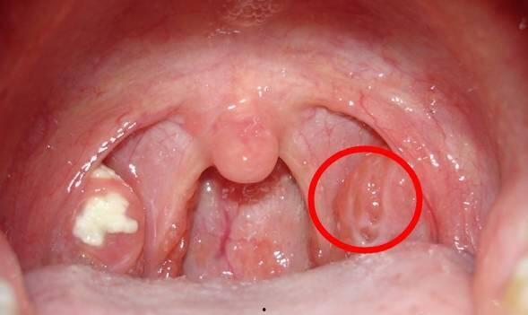 扁桃体发炎肿大图片,症状解析与应对策略