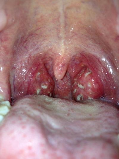 扁桃体发炎肿大图片,症状解析与应对策略